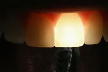 Les moyens de détection des lésions carieuses – odontologie conservatrice