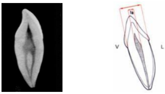 MORPHOLOGIE DENTAIRE DE L’ADULTE : LES CANINES / Anatomie dentaire