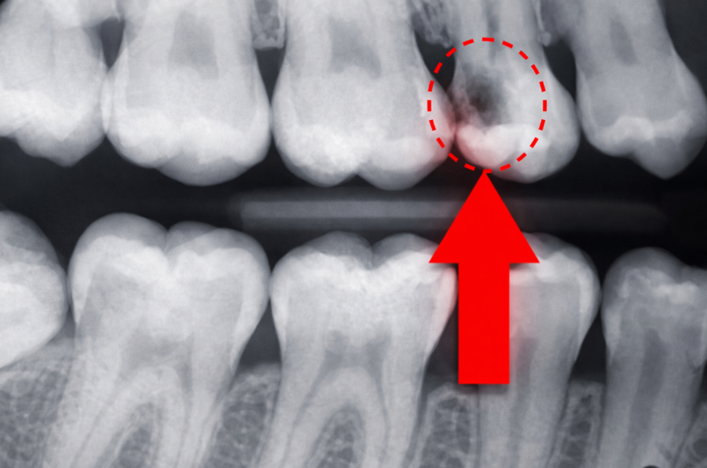 Guide Complet de la Radiographie Endo-Buccale en Odontologie
