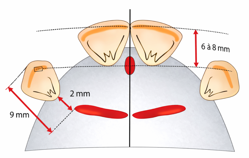 Montage des incisives dans le plan horizontal