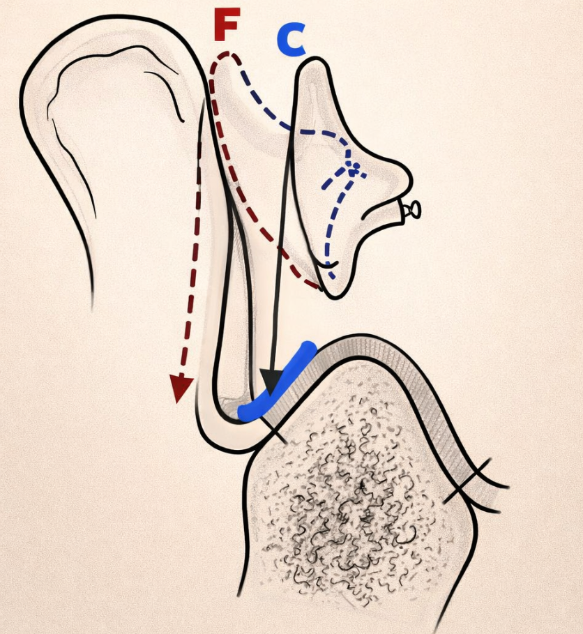 C= position correcte des incisives inférieures.
F= position erronée des incisives inférieures.