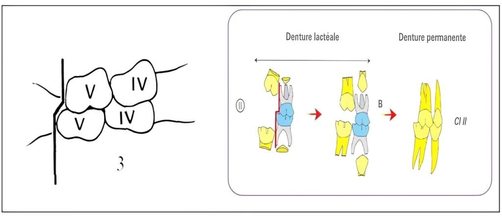 Plan terminal à marche distale La face distale de la deuxième molaire inférieure est en arrière de celle de la supérieure. Cette configuration conduit invariablement à une classe II d'Angle, nécessitant souvent une intervention orthodontique.