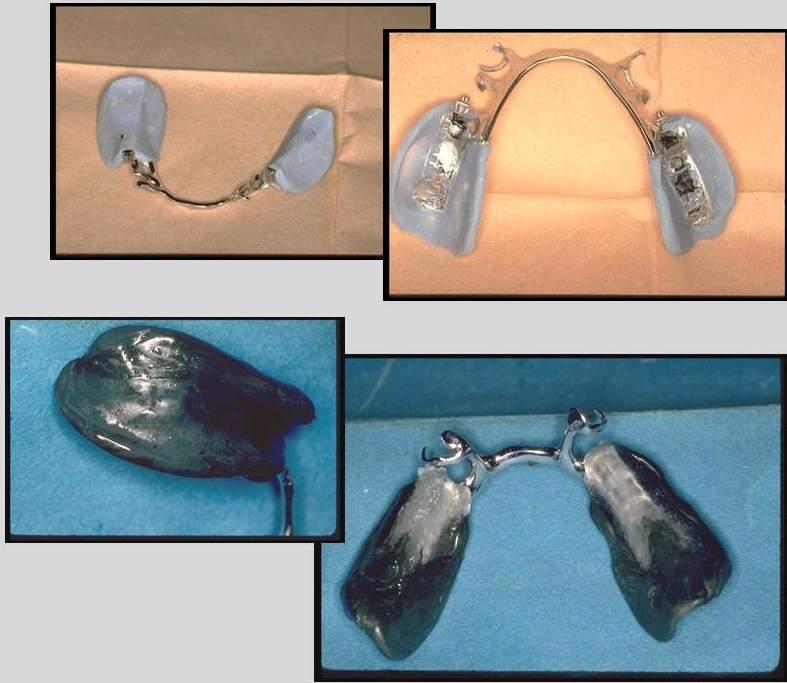 Prothèse Partielle à Châssis Métallique