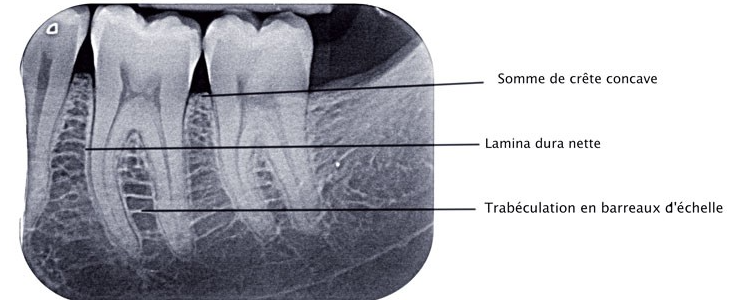 rétroalvéolaire normale espace desmodontal visible, lamina dura