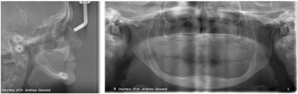 alveolar ridge resorption edentulous panoramic xray