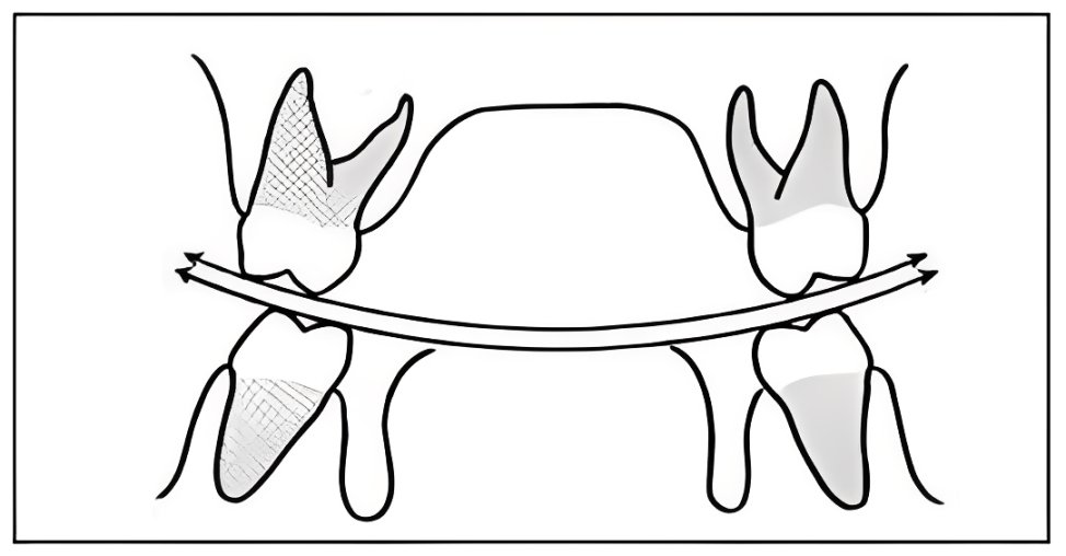 Courbe de Wilson Courbe frontale à concavité supérieure reliant les sommets cuspidiens vestibulaires et linguaux des prémolaires et molaires. Elle garantit le maintien des contacts lors des mouvements de latéralité.