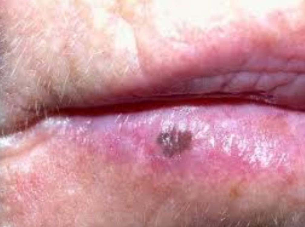  macule mélanotique labiale (macule brune sur lèvre inférieure)