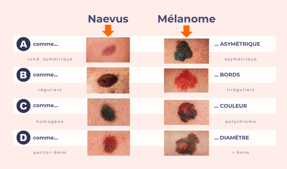 Illustration de la règle ABCDE (schéma comparatif bénin vs malin)
