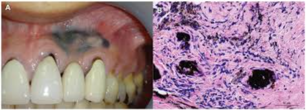  tatouage à l'amalgame 