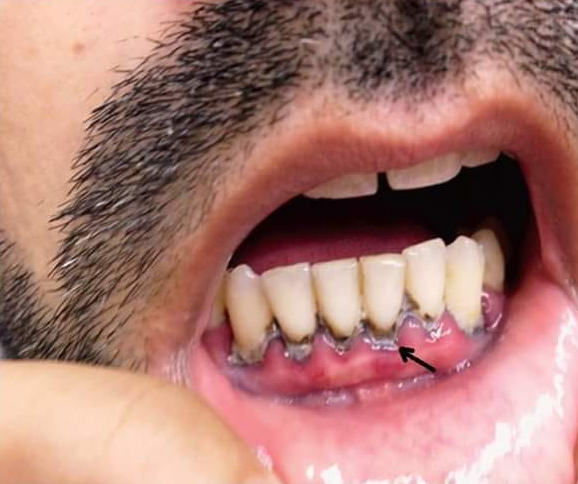 Photo clinique : liseré de Burton (liseré ardoisé au niveau des collets)