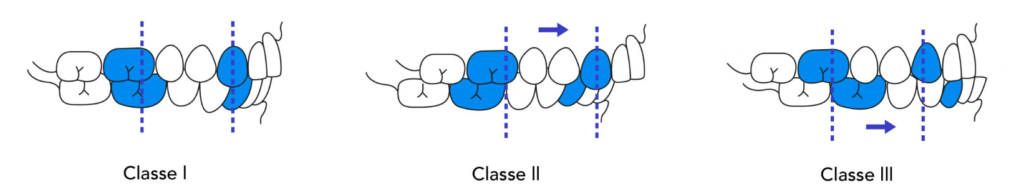 schéma classique comparant les 3 classes d'occlusion en vue latérale