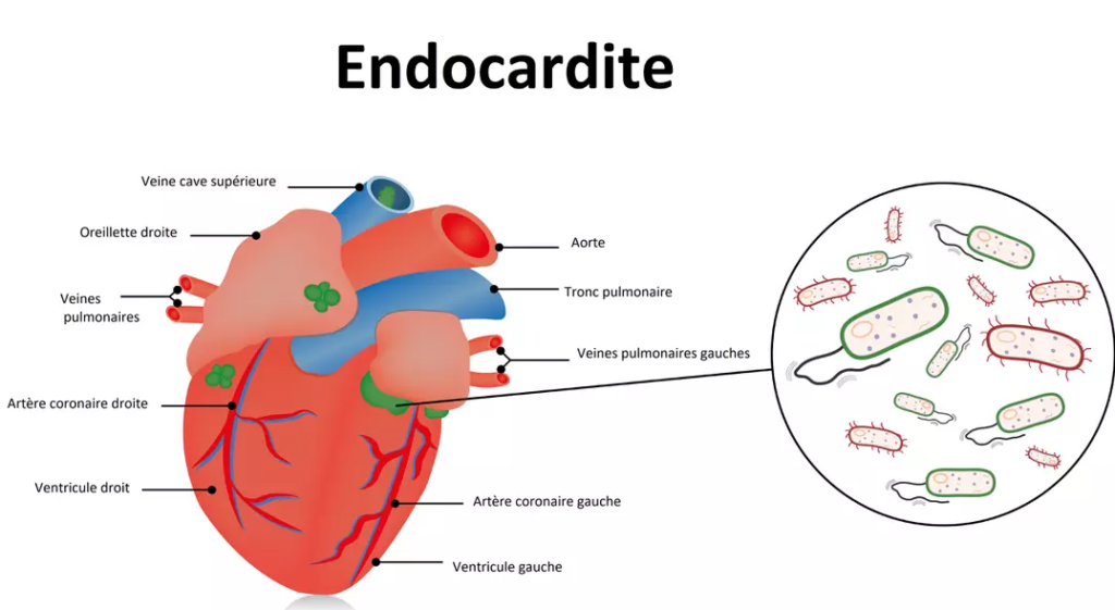endocardite bactérienne valve cardiaque infection illustration médicale
