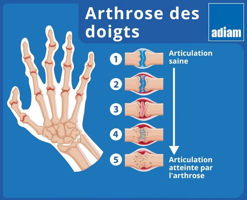 : arthrite inflammation articulaire main douleur articulaire
