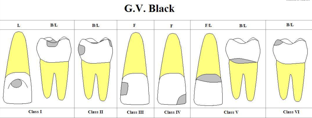 Schéma des 5 classes de Black (diagramme anatomique) dentaire