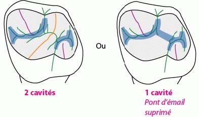 oblique ridge upper molar occlusal anatomy