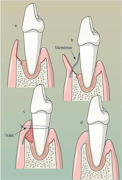 Illustration du potentiel régénératif desmodontal (RTG — régénération tissulaire guidée)