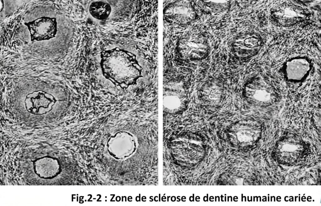 sur le plan histologique :
Le succès d’un coiffage dentinaire se traduit par une disparition de la zone pulpaire enflammée et la formation de la sclérodentine.

Cette sciérodentine va se déposer dans la lumière des canalicules entraînant leur occlusion progressive.