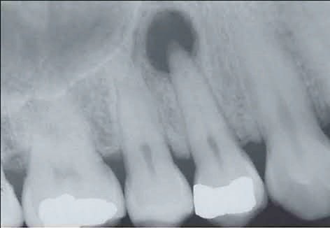 granulome apical radiographie dentaire lésion périapicale
