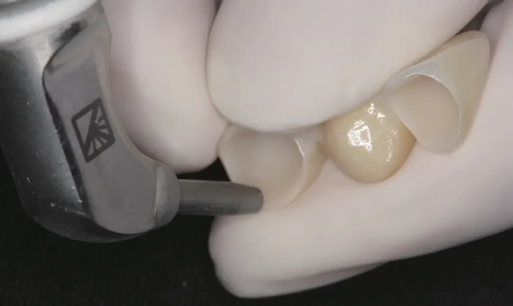 zirconia crown sandblasting alumina dental