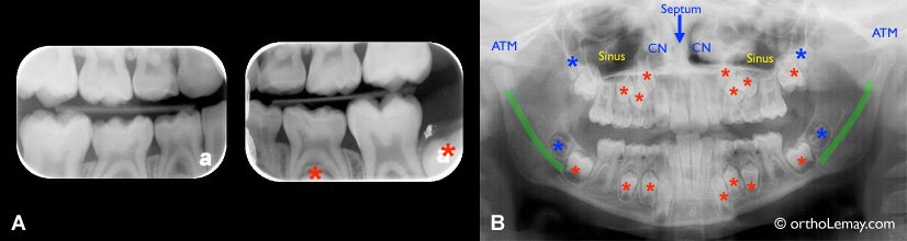 clichés rétrocoronaires utilisés pour le diagnostic des lésions proximales