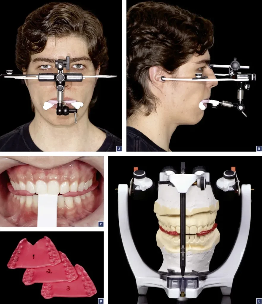 Modèles en plâtre en occlusion sur articulateur