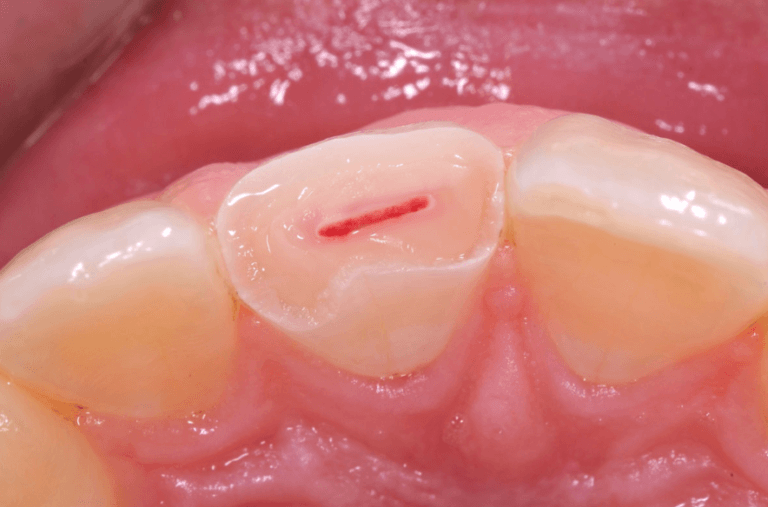 dental pulp exposure accidental clinical