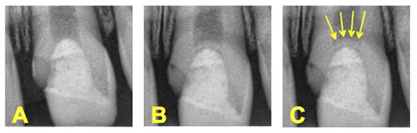  dentinal bridge formation radiograph