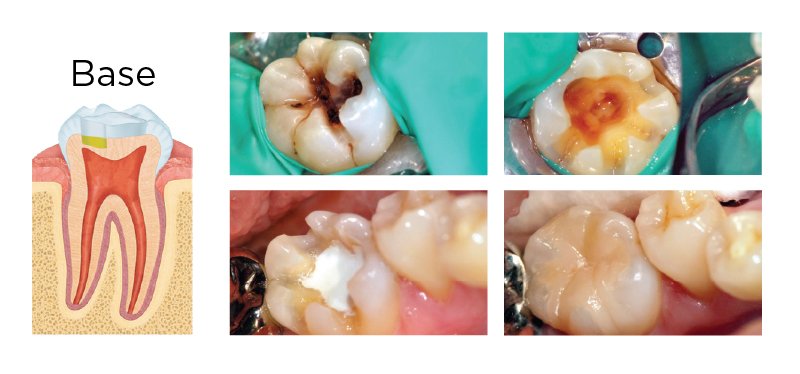 MTA mineral trioxide aggregate dental pulp capping