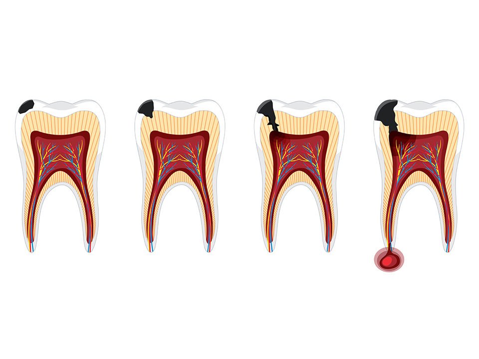 tooth decay progression stages diagram