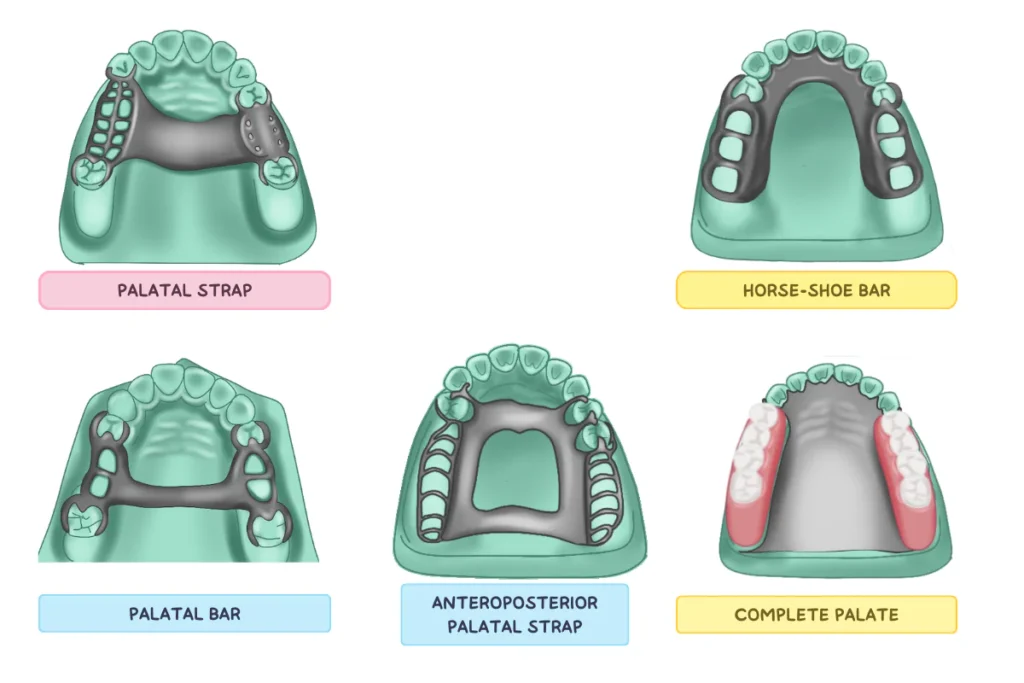 palatal connector major connector RPD, plaque palatine châssis, major connector maxillary denture