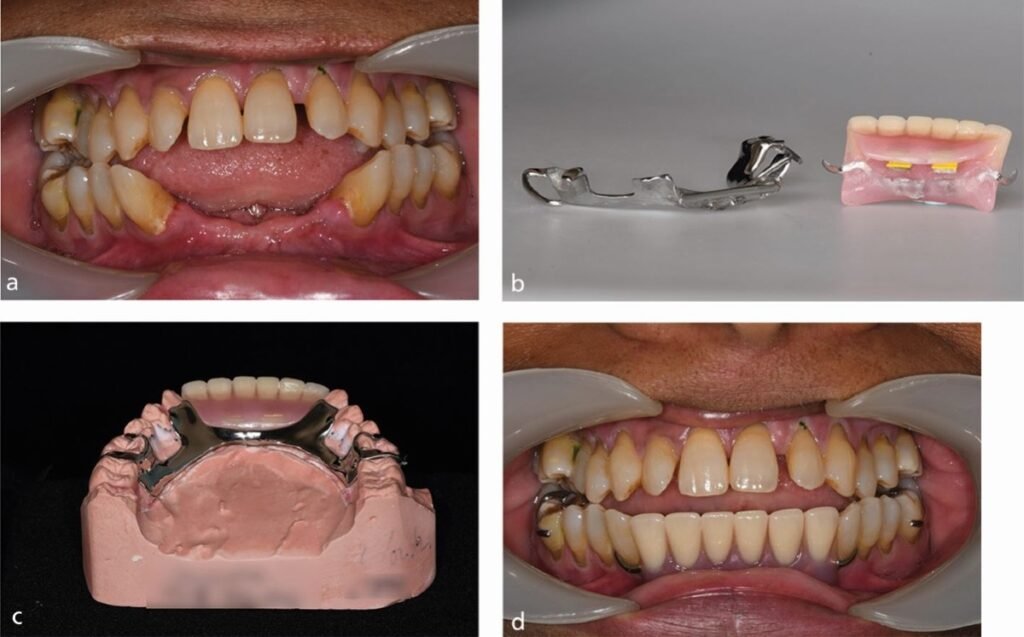 partial removable denture in mouth, prothèse partielle amovible, removable partial denture patient