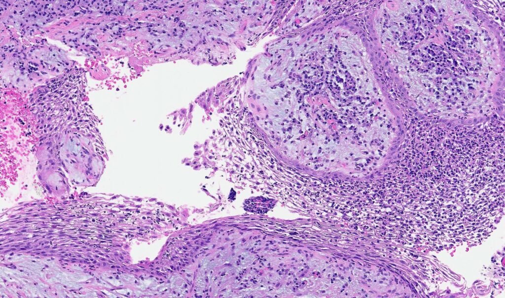 radicular cyst histology epithelium cholesterol