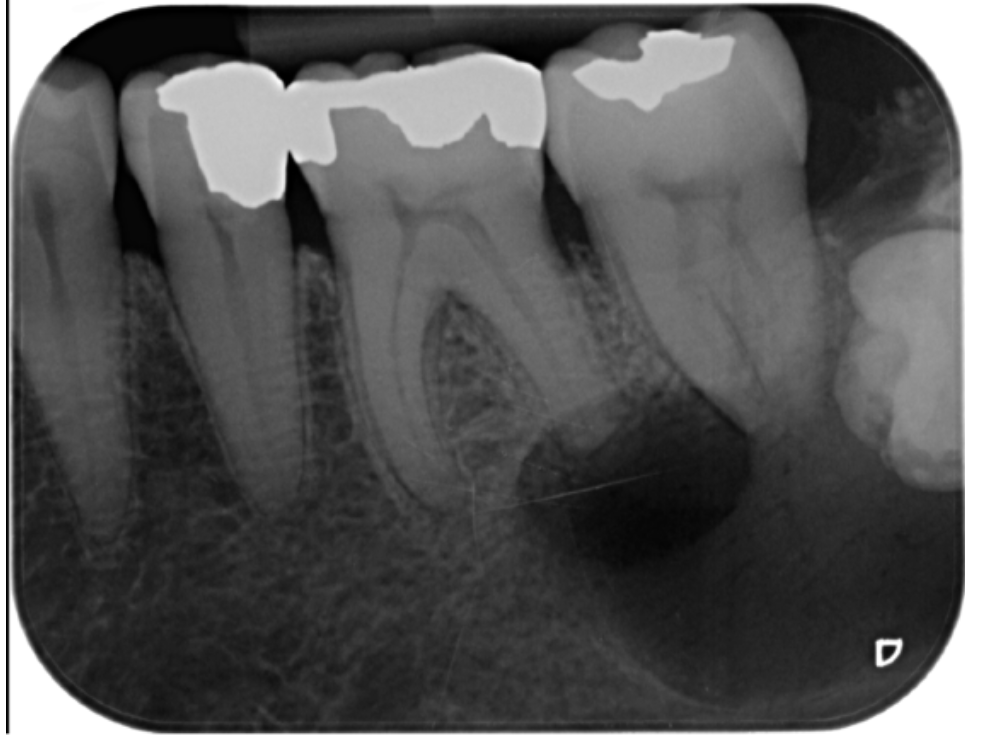 periapical cyst radicular cyst dental xray