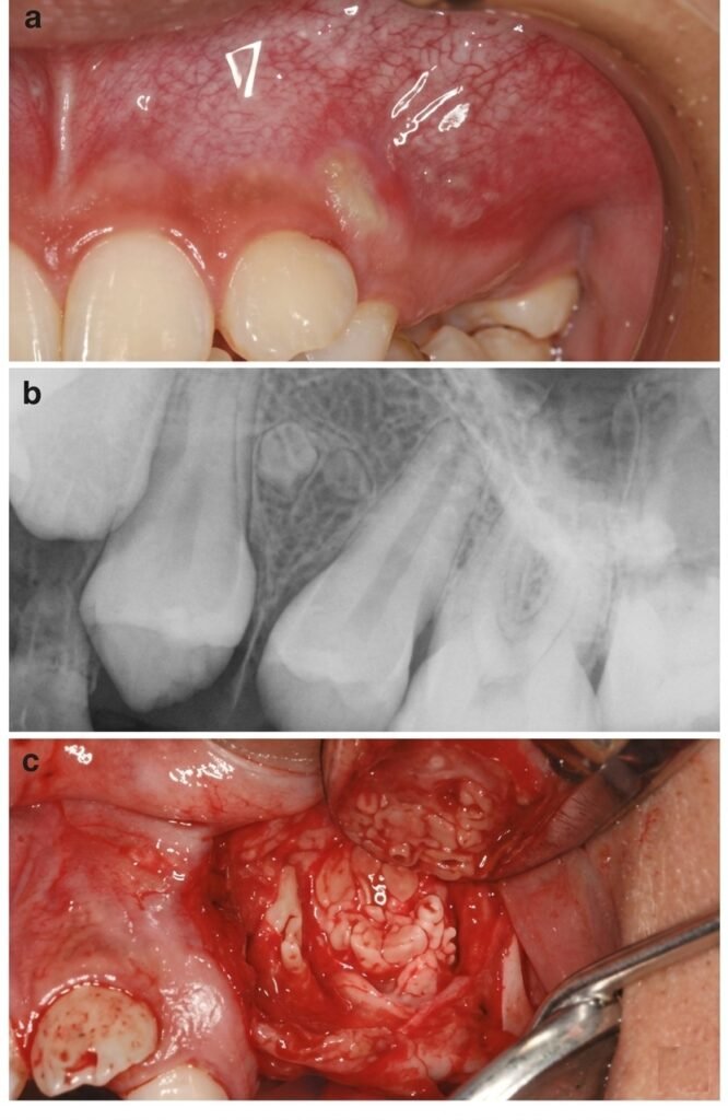 dental cyst swelling vestibular clinical photo - Photo clinique d'une voussure vestibulaire (phase de déformation)