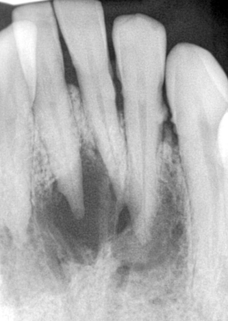 Image radiographique du granulome (image radioclaire < 5mm)