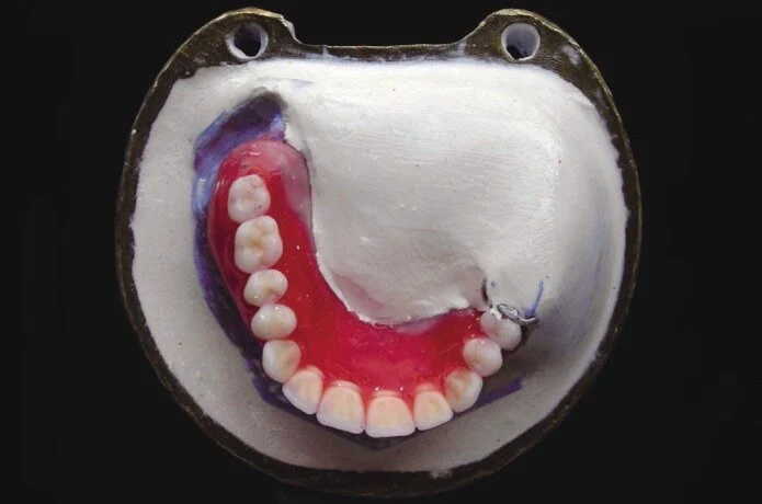 Mise en moufle maquette cire prothèse dentaire