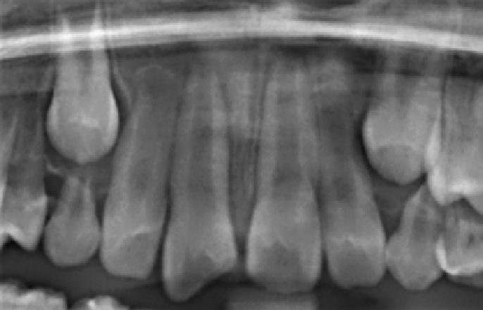 immature apex open apexogenesis young tooth radiograph