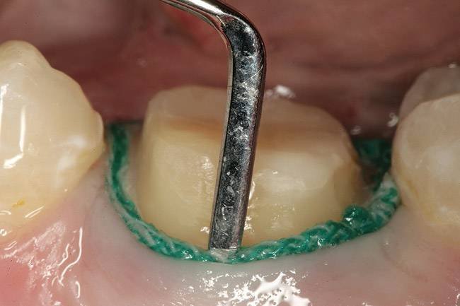 Mise en place d'un fil rétracteur dans le sulcus gingival
