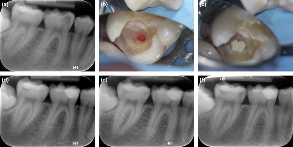  Radiographie montrant une carie profonde proche de la pulpe