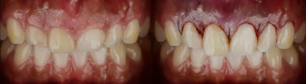 Résultat d'une gingivectomie-plastie sur hyperplasie gingivale