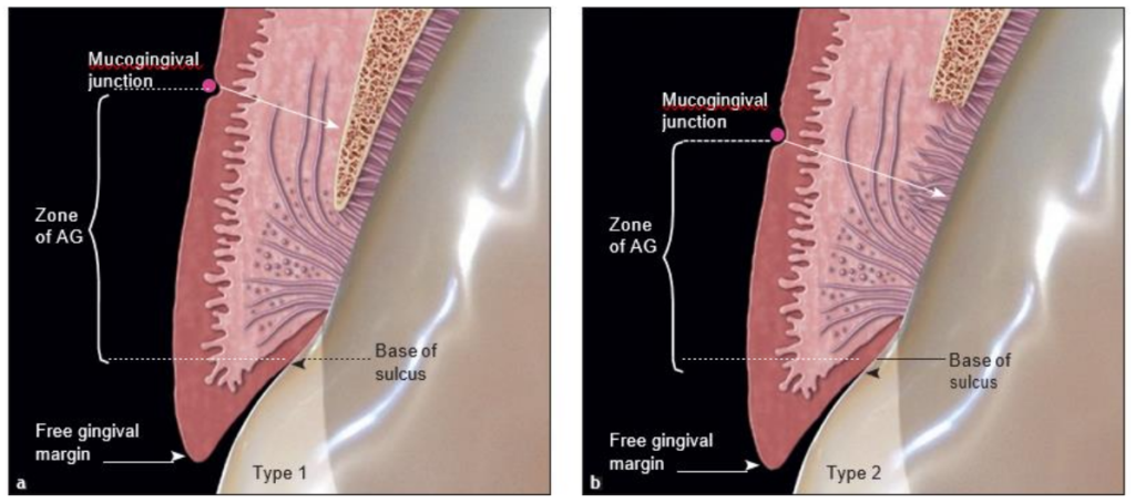 Figure 1 : Dent saine avec la MGJ apicale à la crête osseuse. Partie A de la nouvelle définition. L’AG va de la base du sulcus à la MGJ.
(a) Type 1 : L’AG est attachée via l’épithélium jonctionnel, les fibres du tissu conjonctif et le périoste sur l’os.
(b) Type 2 : L’AG est attachée via l’épithélium jonctionnel et les fibres du tissu conjonctif, mais n’est pas attachée à l’os.