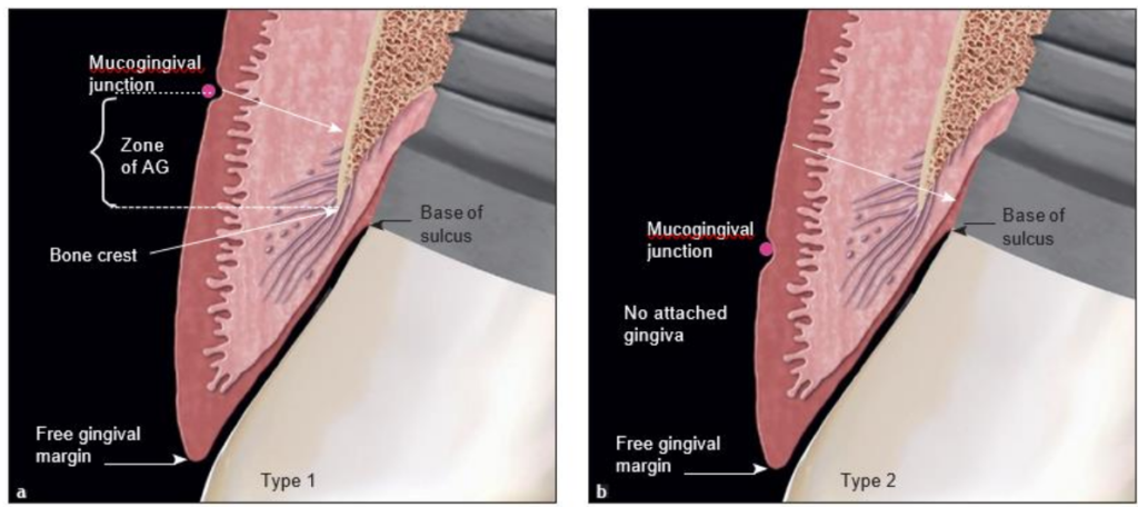 Figure 2 : Implants sains au niveau de l’os. La MGJ est apicale par rapport à la crête osseuse.
(a) Type 1 : La zone d’AG est mesurée de la crête osseuse à la MGJ, attachée uniquement à l’os et non à la dent.
(b) Type 2 : Il n’y a pas de GA, seulement une zone de tissu kératinisé.
