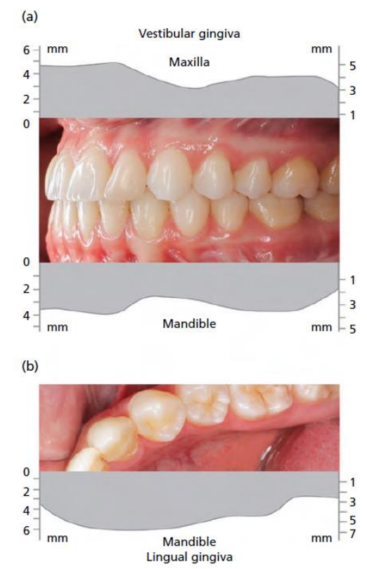 Figure 7 : Variations de hauteur de gencive attachée.