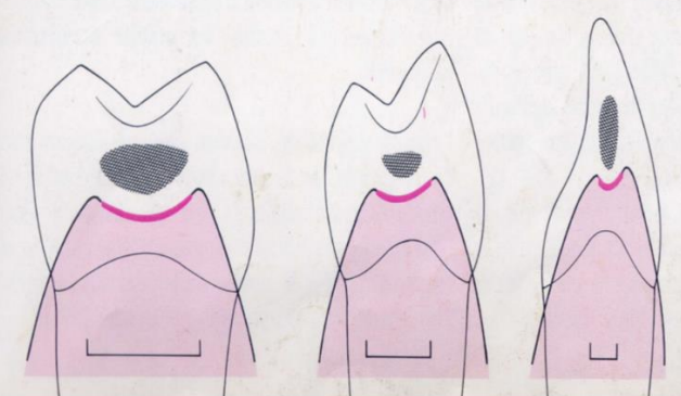 Figure 8 : Col interpapillaire. La morphologie des dents, la largeur des couronnes dentaires et la position des dents les unes par rapport aux autres déterminent l’étendue vestibulo-linguale et corono-apicale des aires de contact et ainsi la largeur et la profondeur du col.
