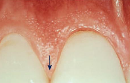 Figure 8 : Gencive papillaire.