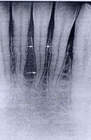 Figure 2 : Aspect radiologique du ligament parodontal.
