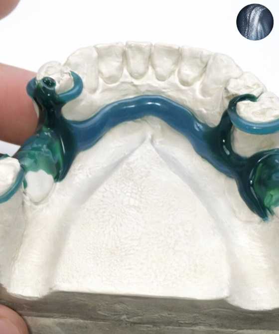 Préparation du modèle avec de la cire Prothèse Partielle Amovible à Châssis Coulé