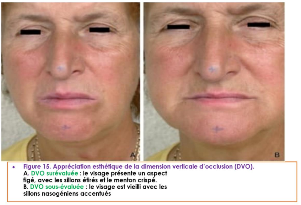 Photo illustrant une DVO effondrée vs une DVO correcte (profil patient)