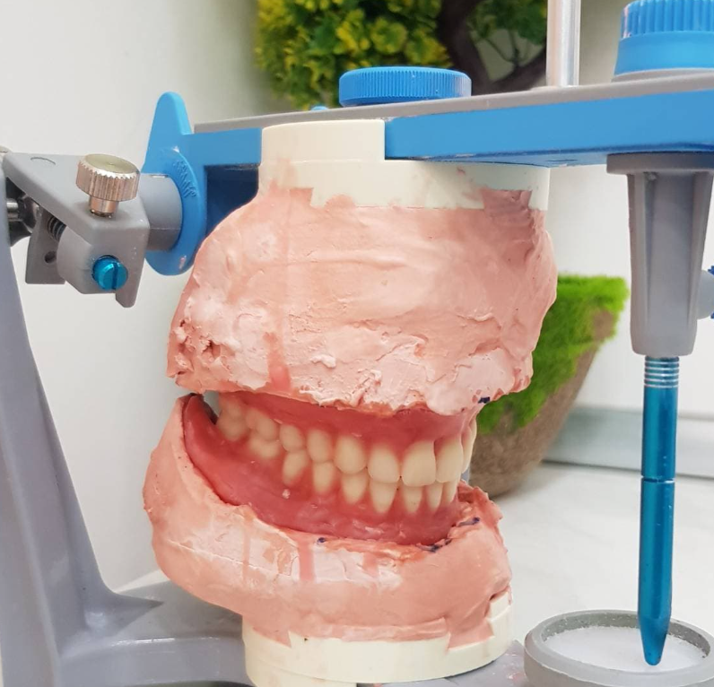 prothèse complète montée sur articulateur avant livraison