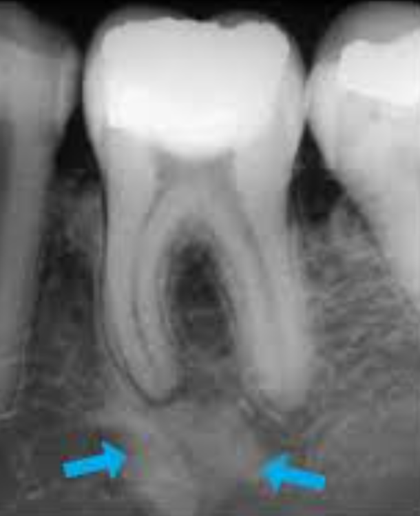 Radiographie montrant l'image hyperdense caractéristique